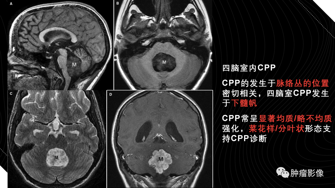影像PPT - 【PPT】儿童后颅窝肿瘤影像诊断-61