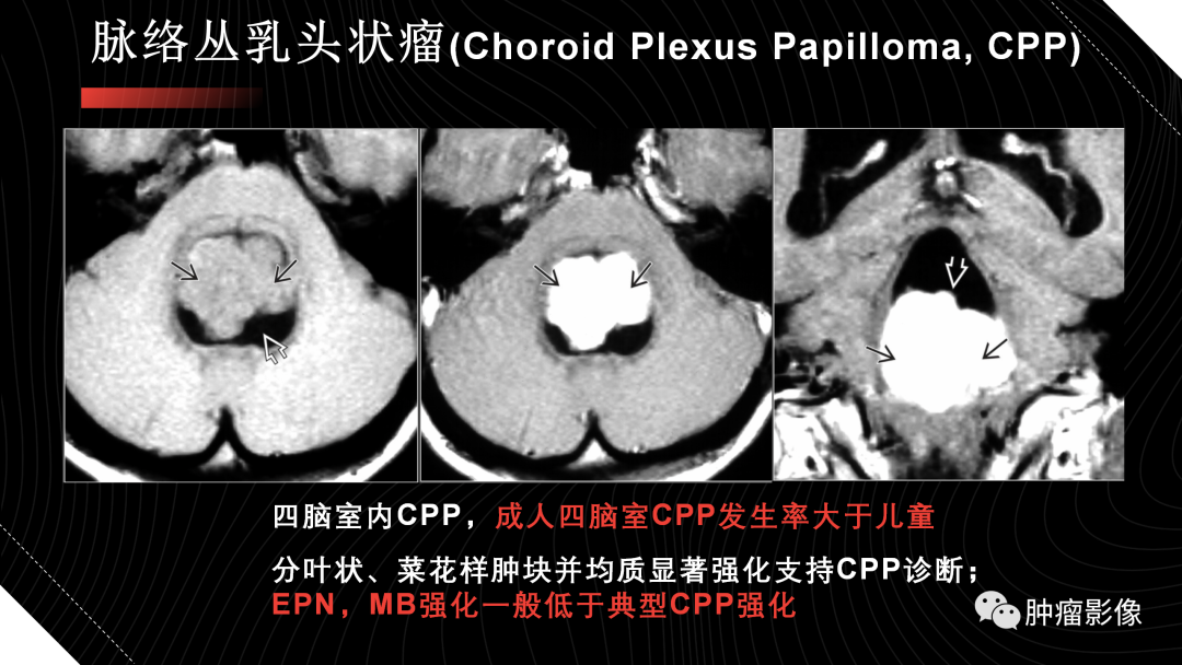影像PPT - 【PPT】儿童后颅窝肿瘤影像诊断-62