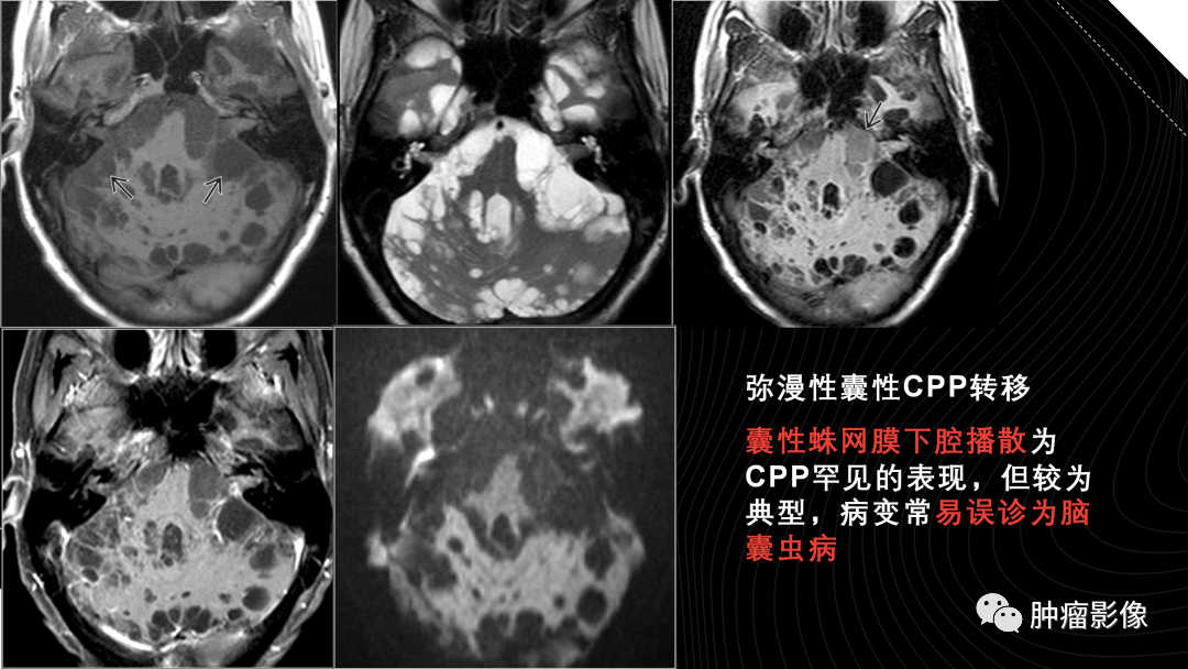 影像PPT - 【PPT】儿童后颅窝肿瘤影像诊断-63