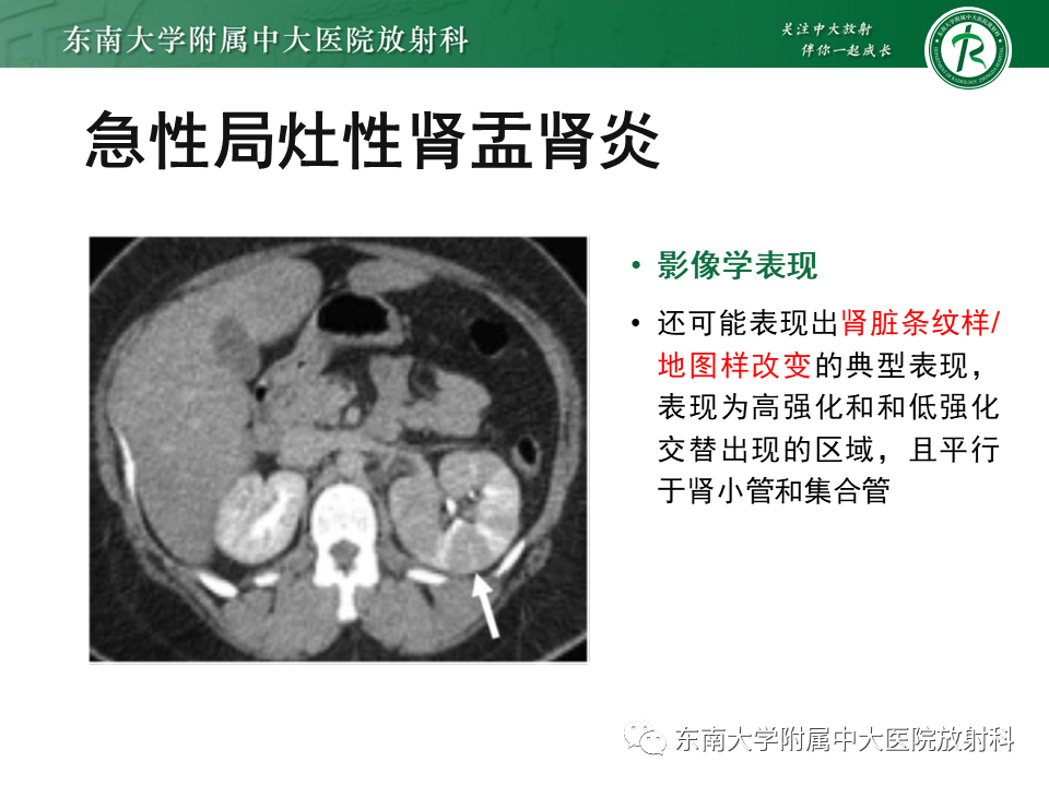影像PPT - “条纹肾”的影像诊断意义-9 影像PPT - “条纹肾”的影像诊断意义-9