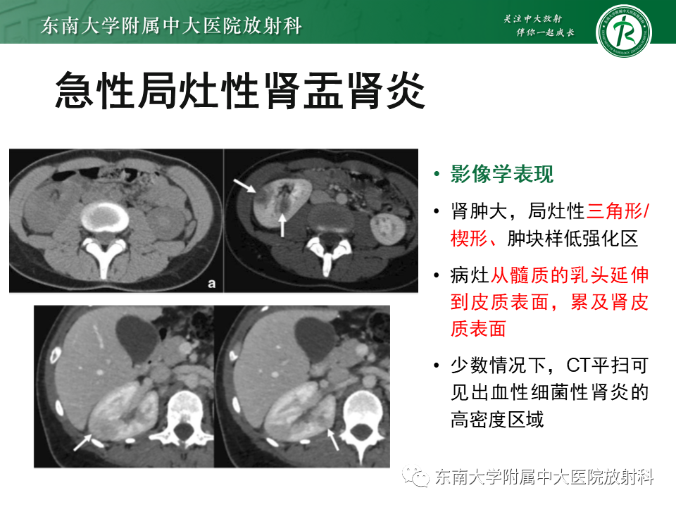 影像PPT - “条纹肾”的影像诊断意义-8 影像PPT - “条纹肾”的影像诊断意义-8