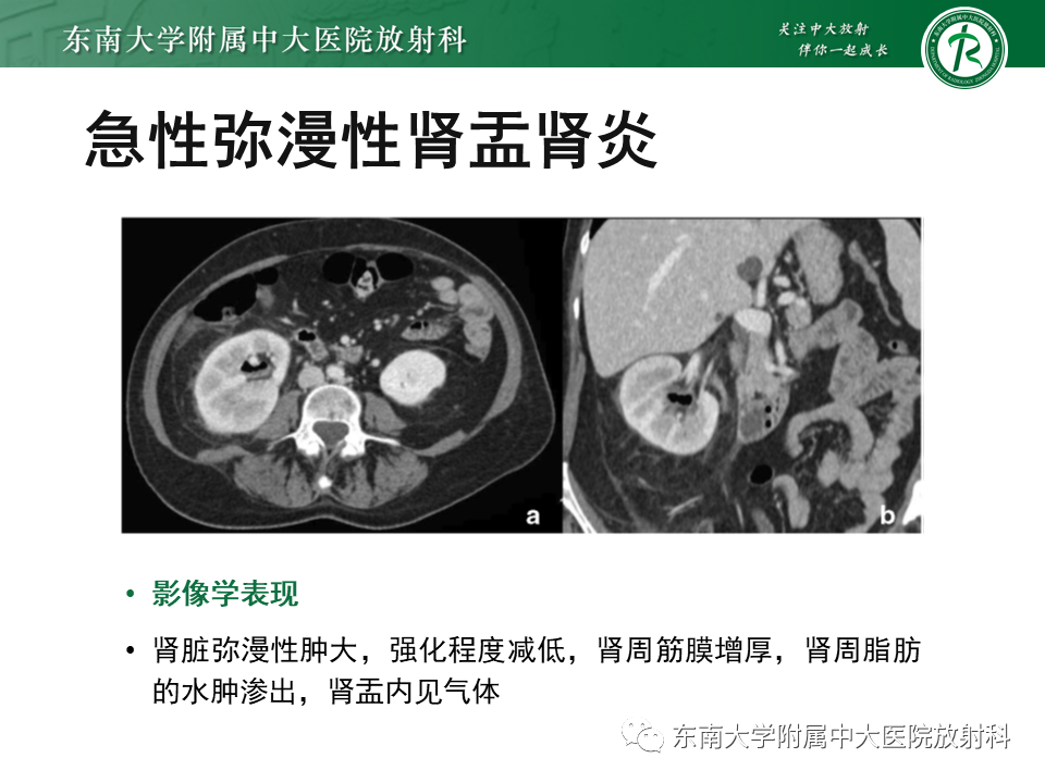 影像PPT - “条纹肾”的影像诊断意义-10 影像PPT - “条纹肾”的影像诊断意义-10