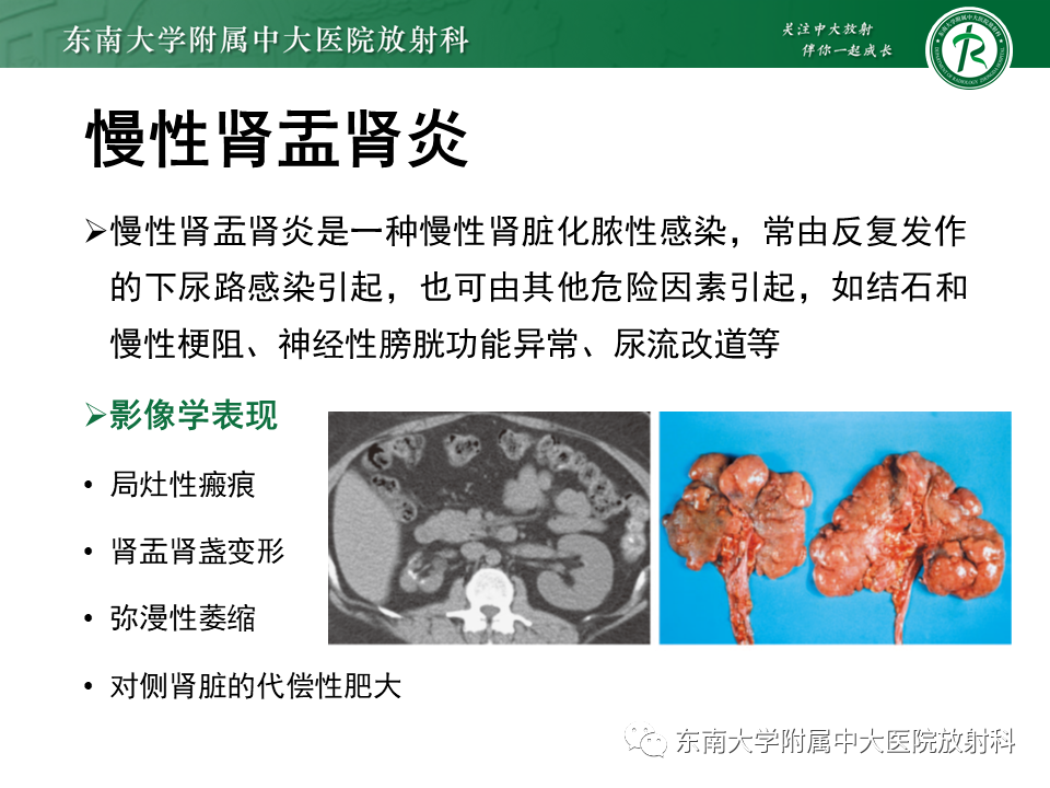 影像PPT - “条纹肾”的影像诊断意义-11 影像PPT - “条纹肾”的影像诊断意义-11