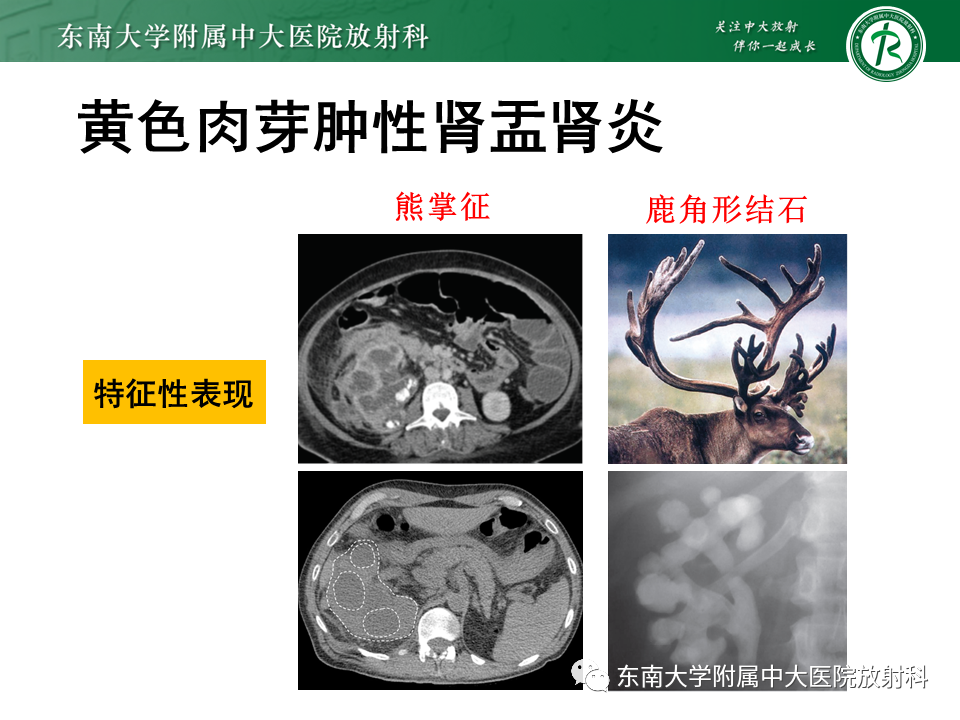 影像PPT - “条纹肾”的影像诊断意义-16 影像PPT - “条纹肾”的影像诊断意义-16