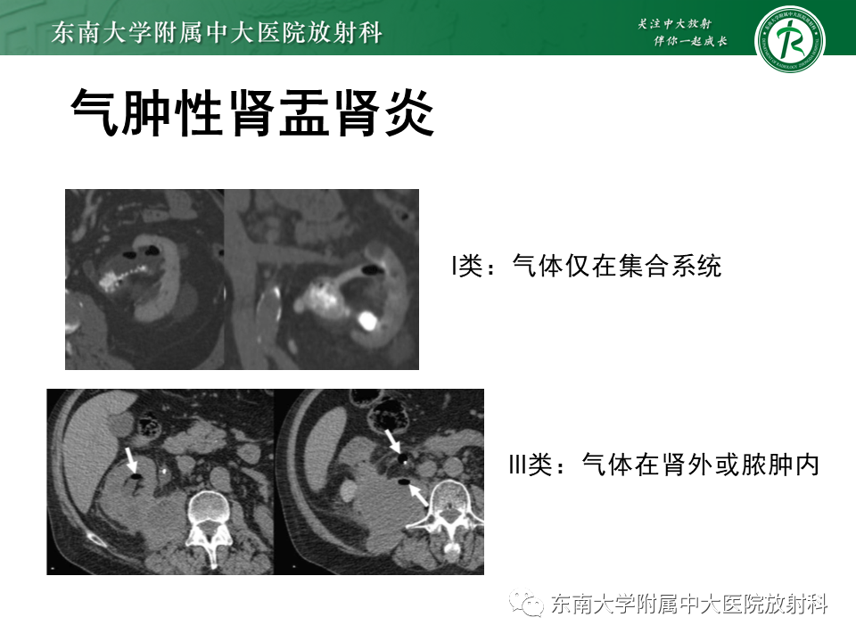 影像PPT - “条纹肾”的影像诊断意义-18 影像PPT - “条纹肾”的影像诊断意义-18