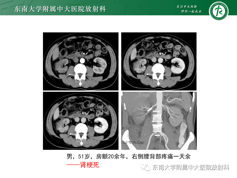 影像PPT - “条纹肾”的影像诊断意义-20 影像PPT - “条纹肾”的影像诊断意义-20
