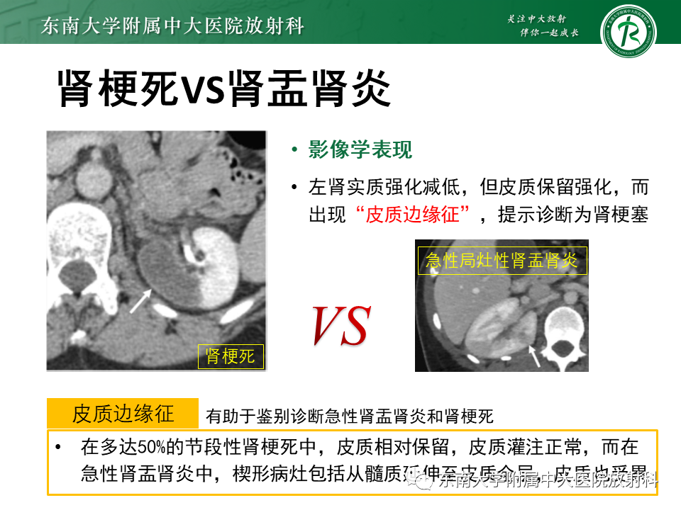 影像PPT - “条纹肾”的影像诊断意义-22 影像PPT - “条纹肾”的影像诊断意义-22