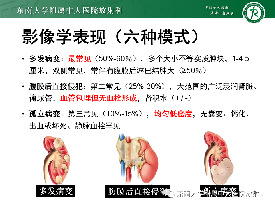 影像PPT - “条纹肾”的影像诊断意义-25 影像PPT - “条纹肾”的影像诊断意义-25