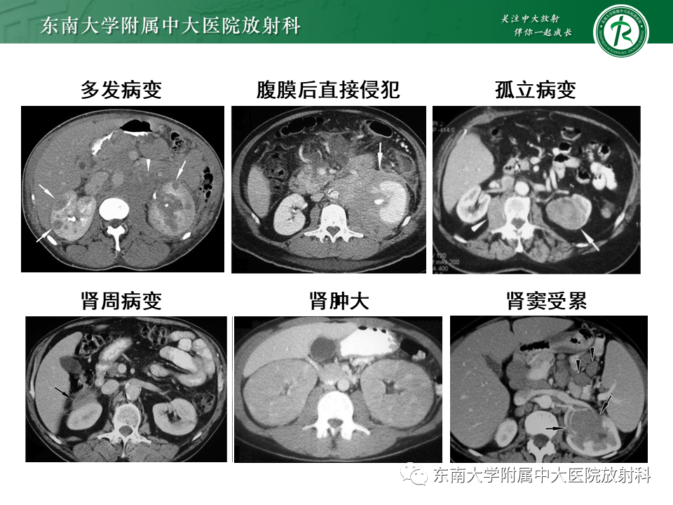 影像PPT - “条纹肾”的影像诊断意义-27 影像PPT - “条纹肾”的影像诊断意义-27