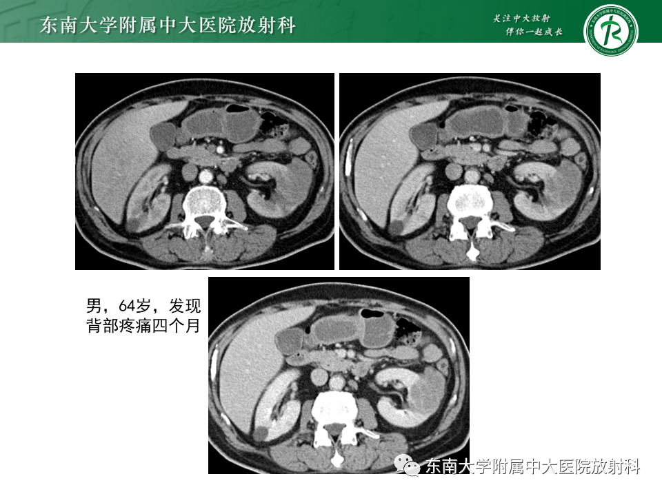 影像PPT - “条纹肾”的影像诊断意义-29 影像PPT - “条纹肾”的影像诊断意义-29