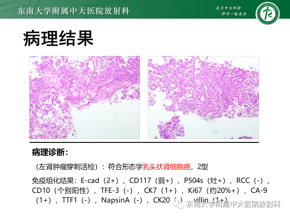 影像PPT - “条纹肾”的影像诊断意义-30 影像PPT - “条纹肾”的影像诊断意义-30
