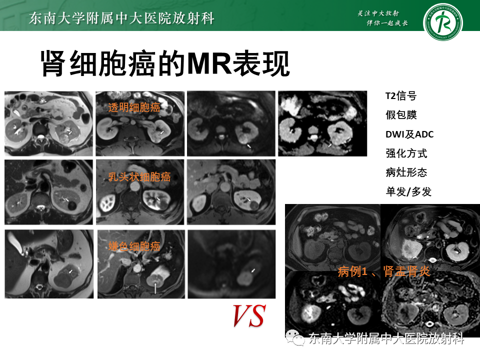 影像PPT - “条纹肾”的影像诊断意义-35 影像PPT - “条纹肾”的影像诊断意义-35