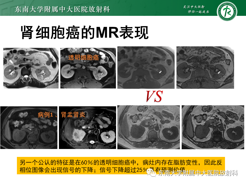 影像PPT - “条纹肾”的影像诊断意义-36 影像PPT - “条纹肾”的影像诊断意义-36