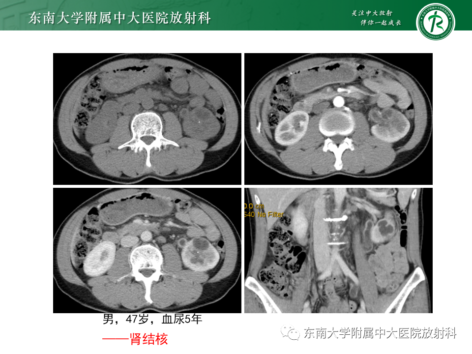 影像PPT - “条纹肾”的影像诊断意义-37 影像PPT - “条纹肾”的影像诊断意义-37