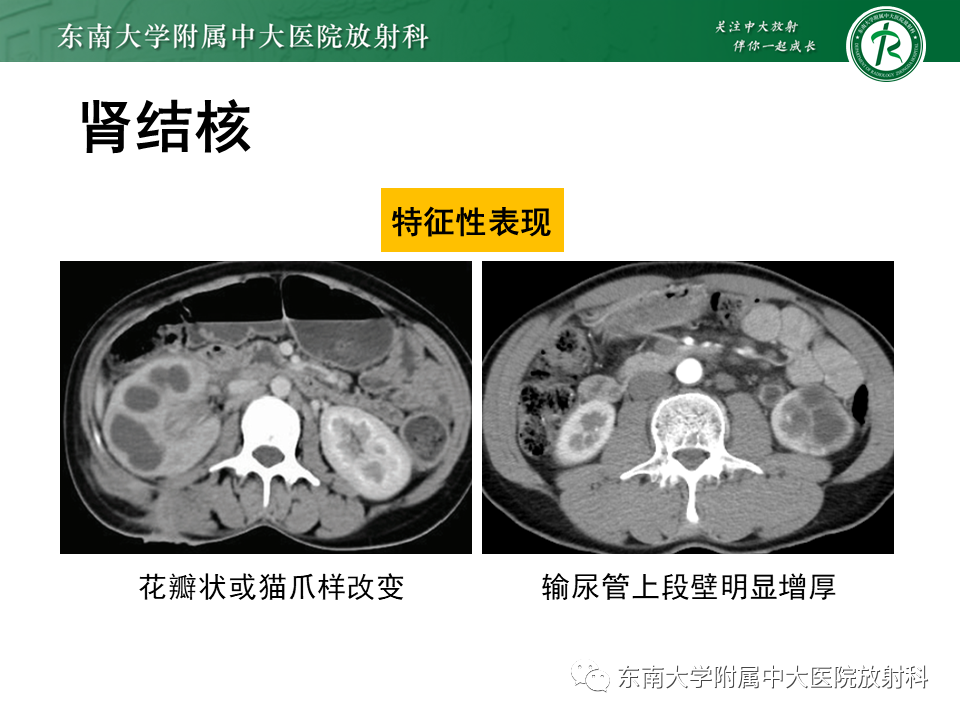 影像PPT - “条纹肾”的影像诊断意义-40 影像PPT - “条纹肾”的影像诊断意义-40