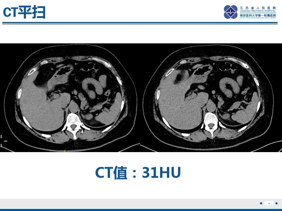 影像PPT - 【PPT】肾上腺腺瘤-4
