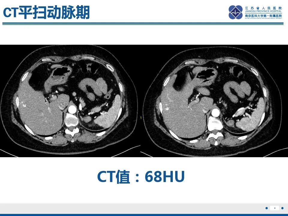 影像PPT - 【PPT】肾上腺腺瘤-5