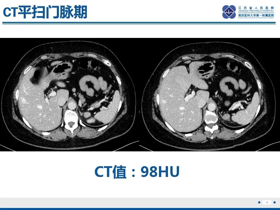 影像PPT - 【PPT】肾上腺腺瘤-6