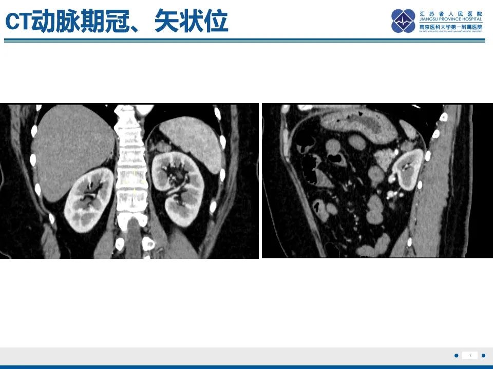 影像PPT - 【PPT】肾上腺腺瘤-7