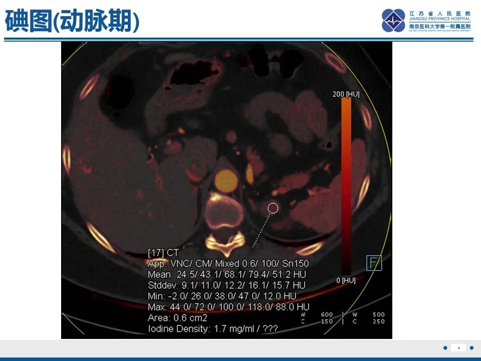 影像PPT - 【PPT】肾上腺腺瘤-8
