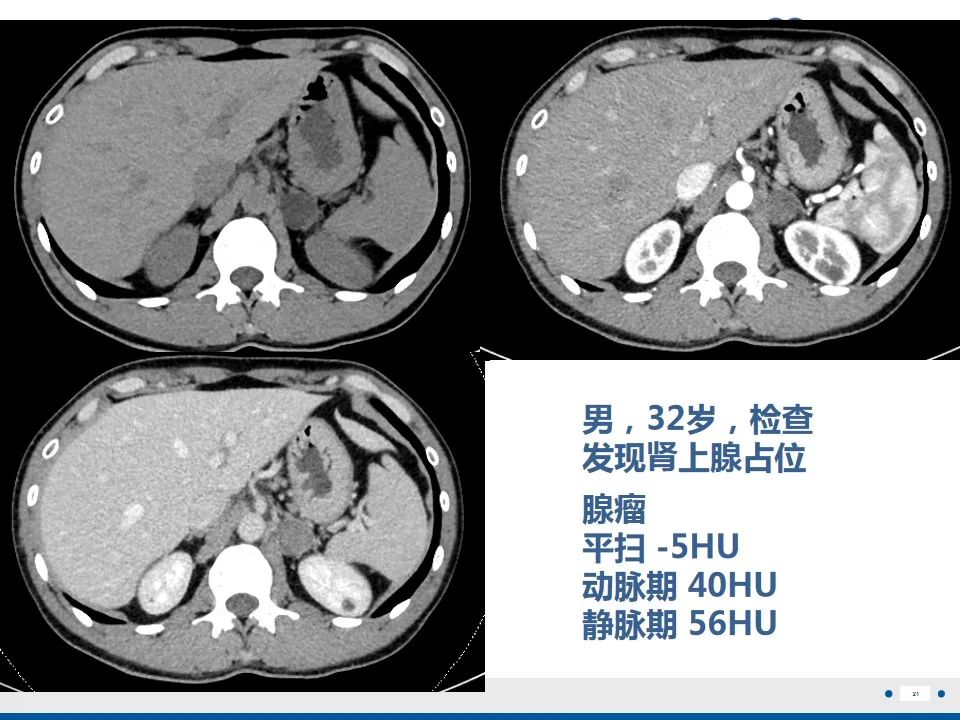影像PPT - 【PPT】肾上腺腺瘤-21