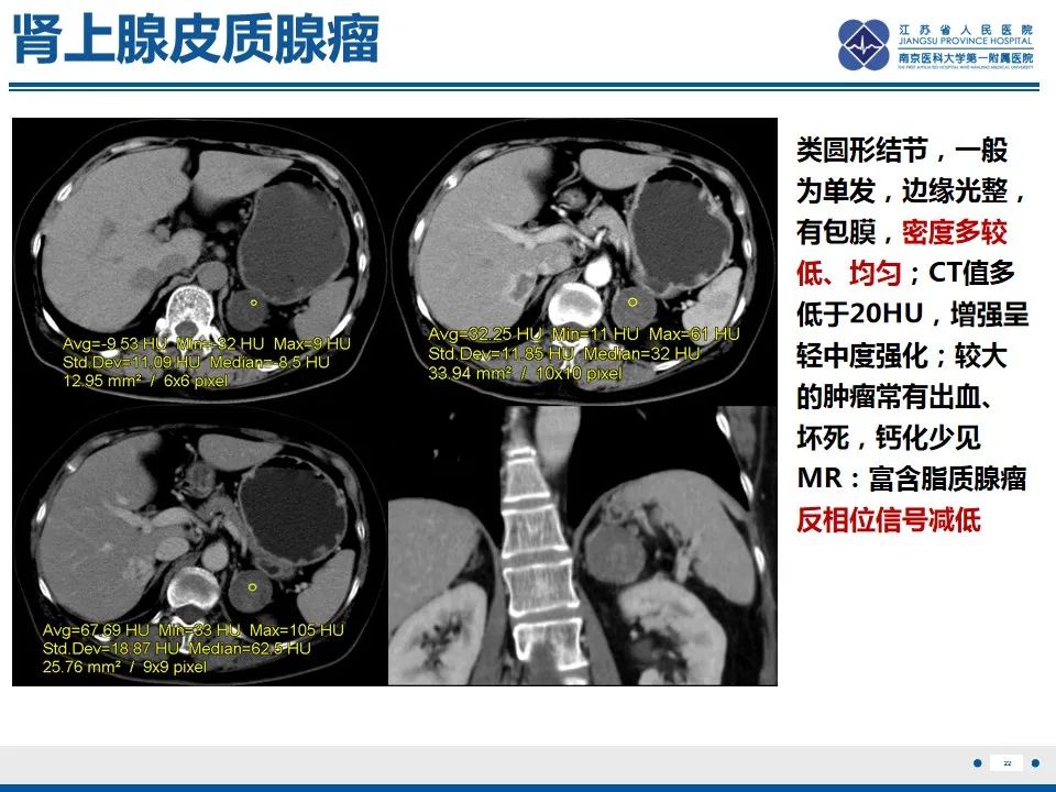 影像PPT - 【PPT】肾上腺腺瘤-22
