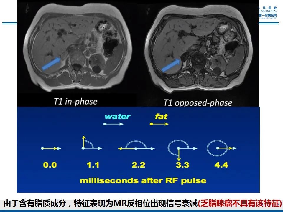 影像PPT - 【PPT】肾上腺腺瘤-24