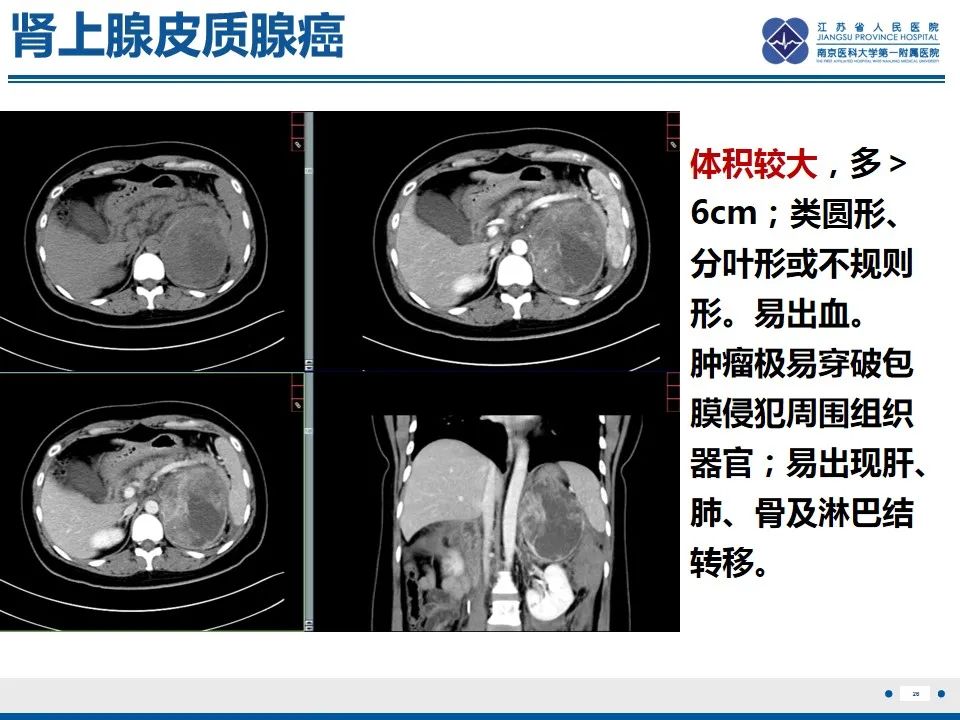 影像PPT - 【PPT】肾上腺腺瘤-26