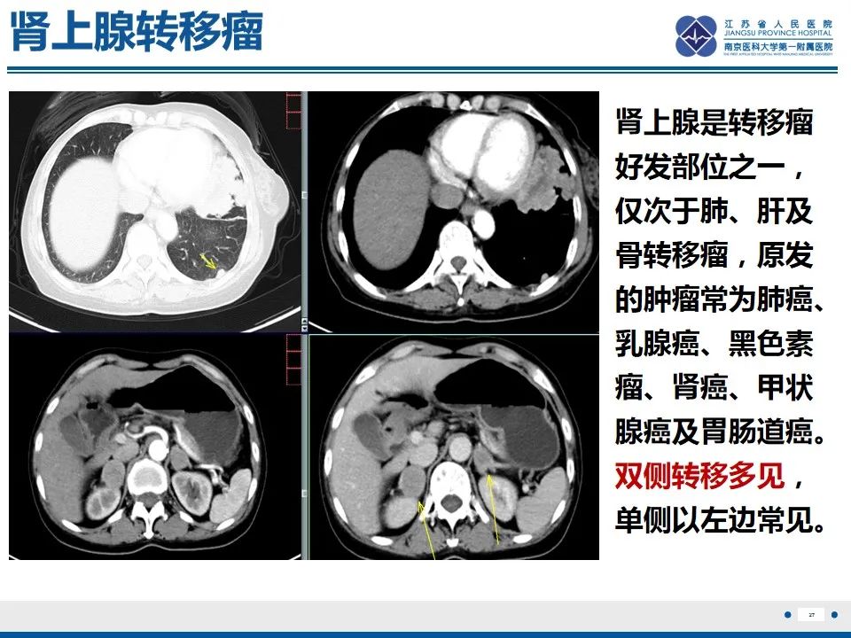 影像PPT - 【PPT】肾上腺腺瘤-27