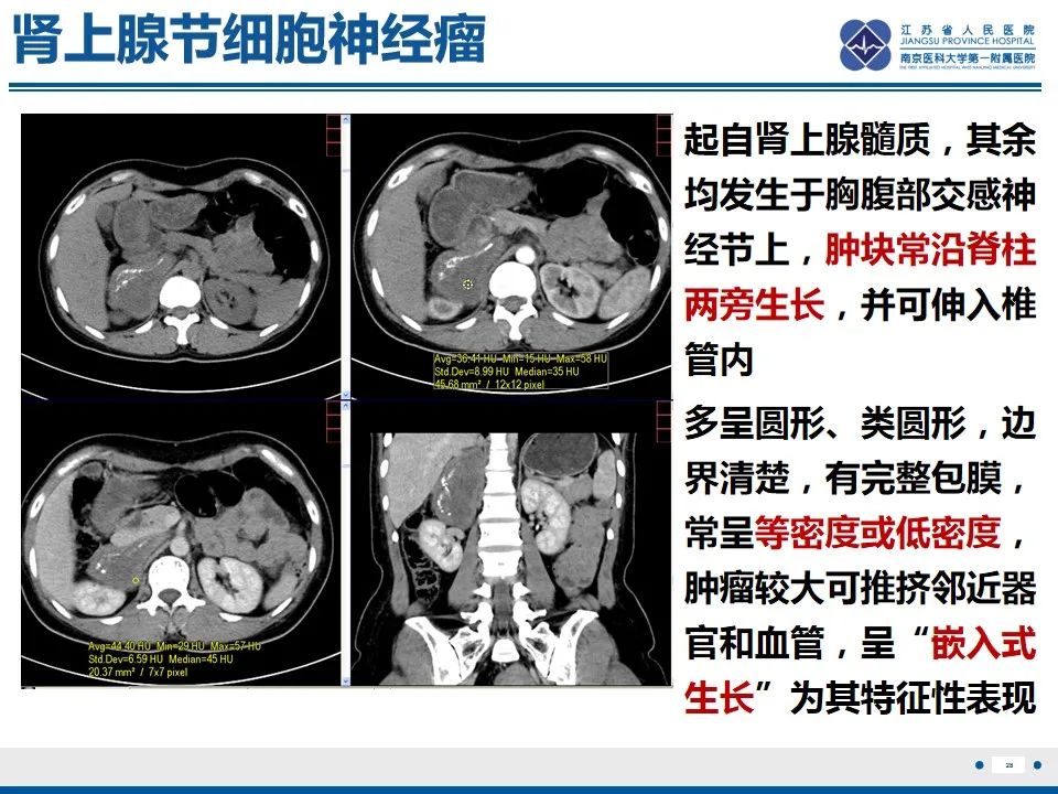 影像PPT - 【PPT】肾上腺腺瘤-28