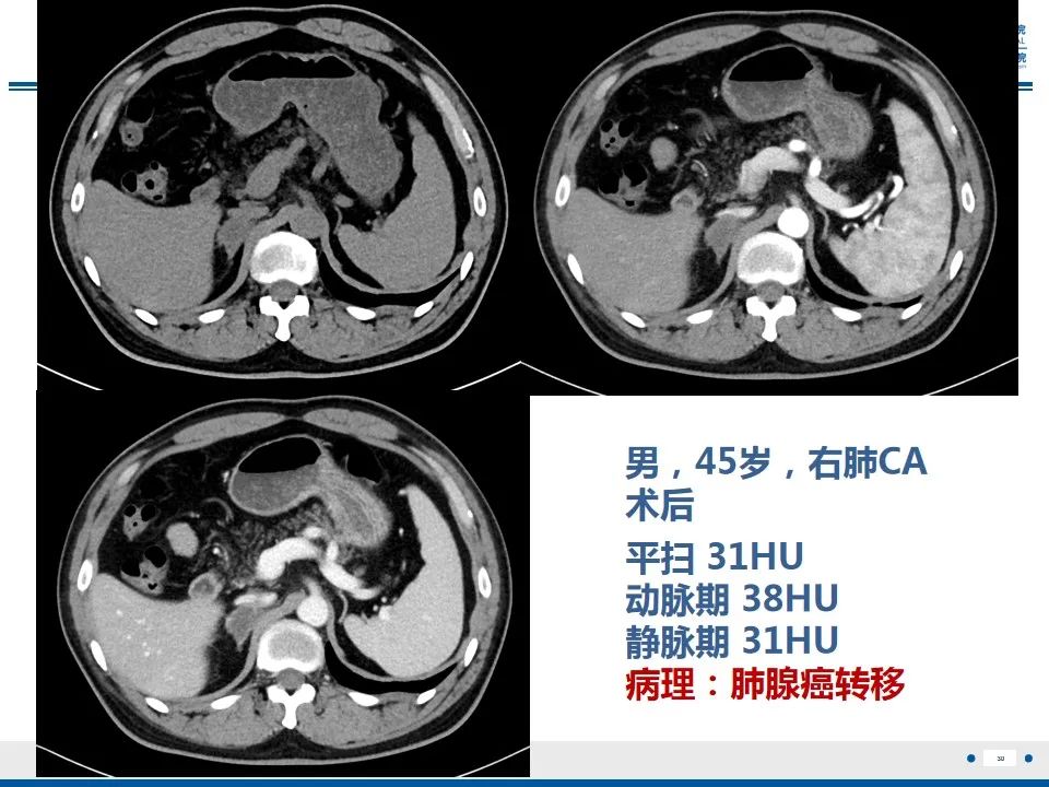 影像PPT - 【PPT】肾上腺腺瘤-30