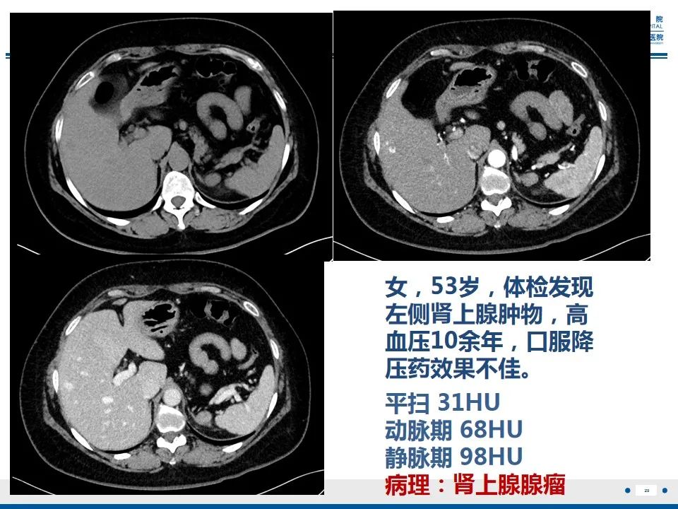影像PPT - 【PPT】肾上腺腺瘤-29