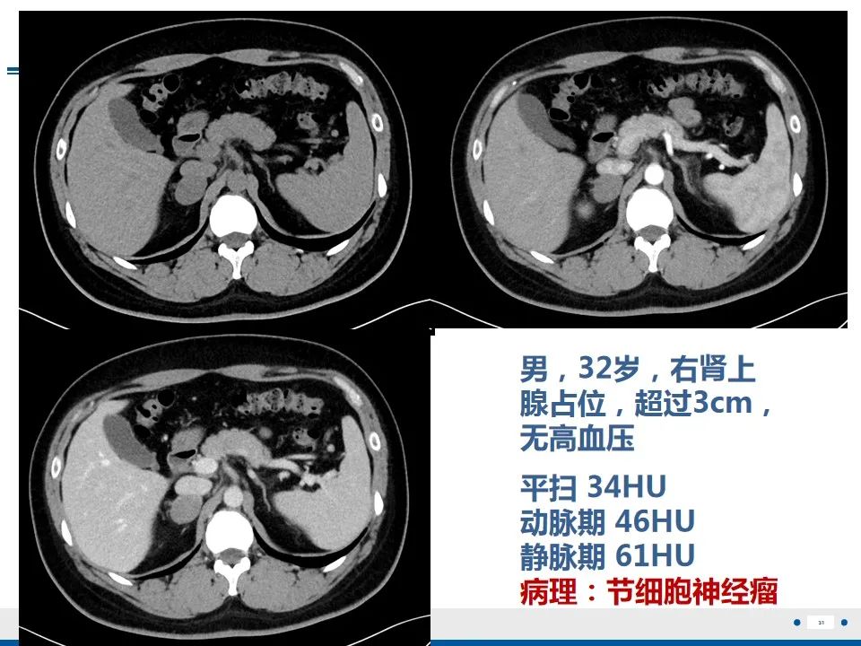影像PPT - 【PPT】肾上腺腺瘤-31