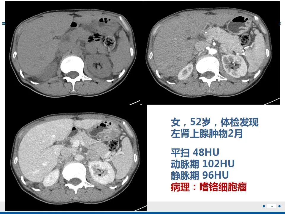 影像PPT - 【PPT】肾上腺腺瘤-32