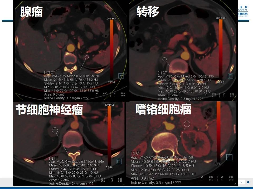影像PPT - 【PPT】肾上腺腺瘤-36