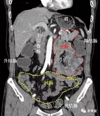 影像PPT - 中肠旋转不良的临床及影像-2 影像PPT - 中肠旋转不良的临床及影像-2