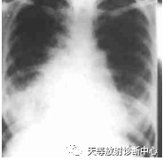 影像PPT - 特发性肺含铁血黄素沉着症-1 影像PPT - 特发性肺含铁血黄素沉着症-1