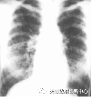 影像PPT - 特发性肺含铁血黄素沉着症-2 影像PPT - 特发性肺含铁血黄素沉着症-2