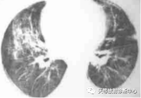 影像PPT - 特发性肺含铁血黄素沉着症-6 影像PPT - 特发性肺含铁血黄素沉着症-6