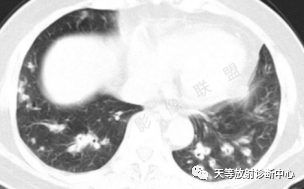 影像PPT - 特发性肺含铁血黄素沉着症-10 影像PPT - 特发性肺含铁血黄素沉着症-10
