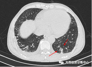 影像PPT - 特发性肺含铁血黄素沉着症-11 影像PPT - 特发性肺含铁血黄素沉着症-11