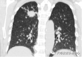 影像PPT - 特发性肺含铁血黄素沉着症-13 影像PPT - 特发性肺含铁血黄素沉着症-13