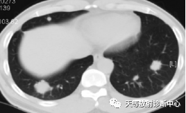 影像PPT - 特发性肺含铁血黄素沉着症-14 影像PPT - 特发性肺含铁血黄素沉着症-14