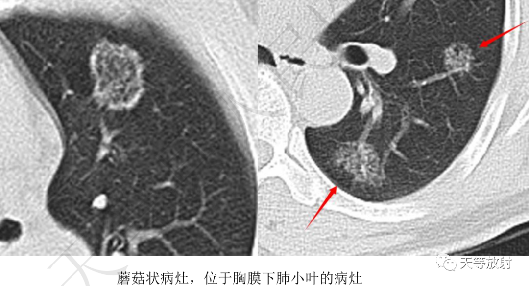 影像PPT - 环礁岛征/反晕征-9 影像PPT - 环礁岛征/反晕征-9