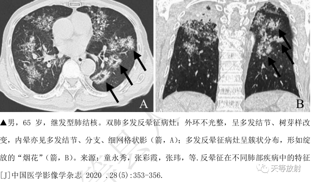 影像PPT - 环礁岛征/反晕征-15 影像PPT - 环礁岛征/反晕征-15