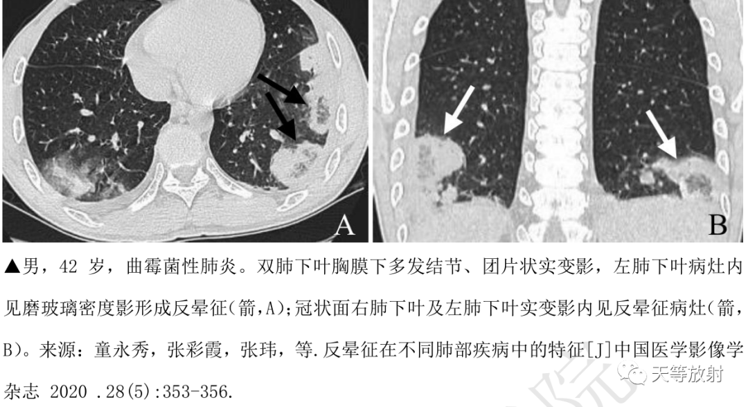 影像PPT - 环礁岛征/反晕征-17 影像PPT - 环礁岛征/反晕征-17