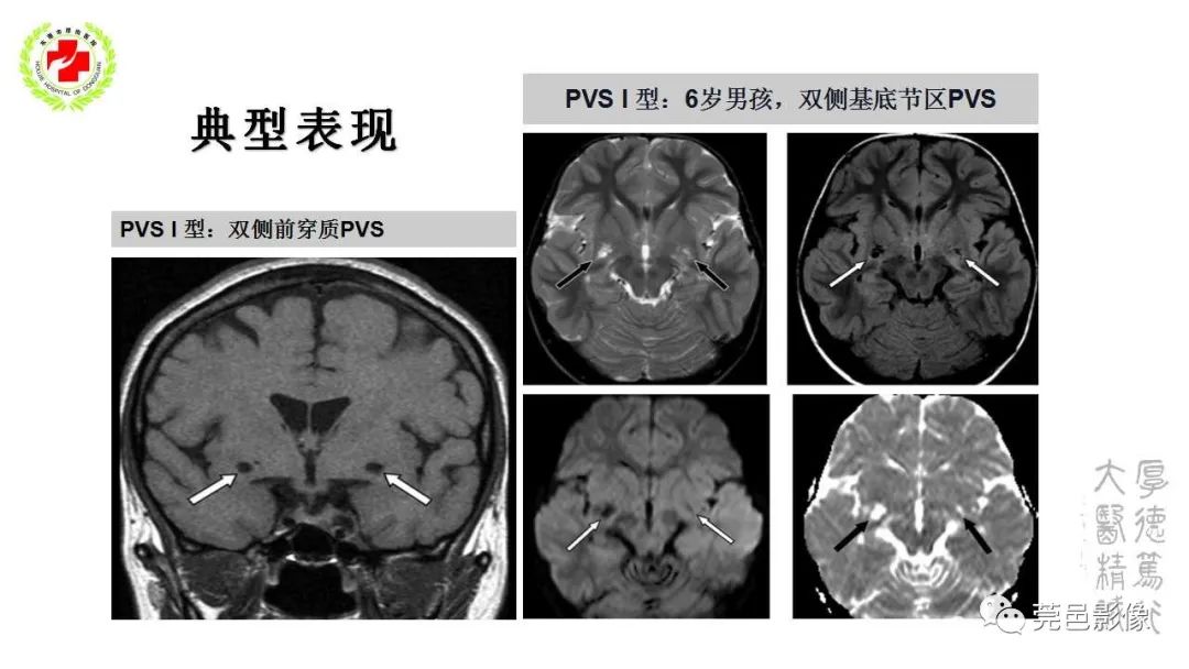 影像PPT - 【PPT】血管周围间隙及相关疾病-10