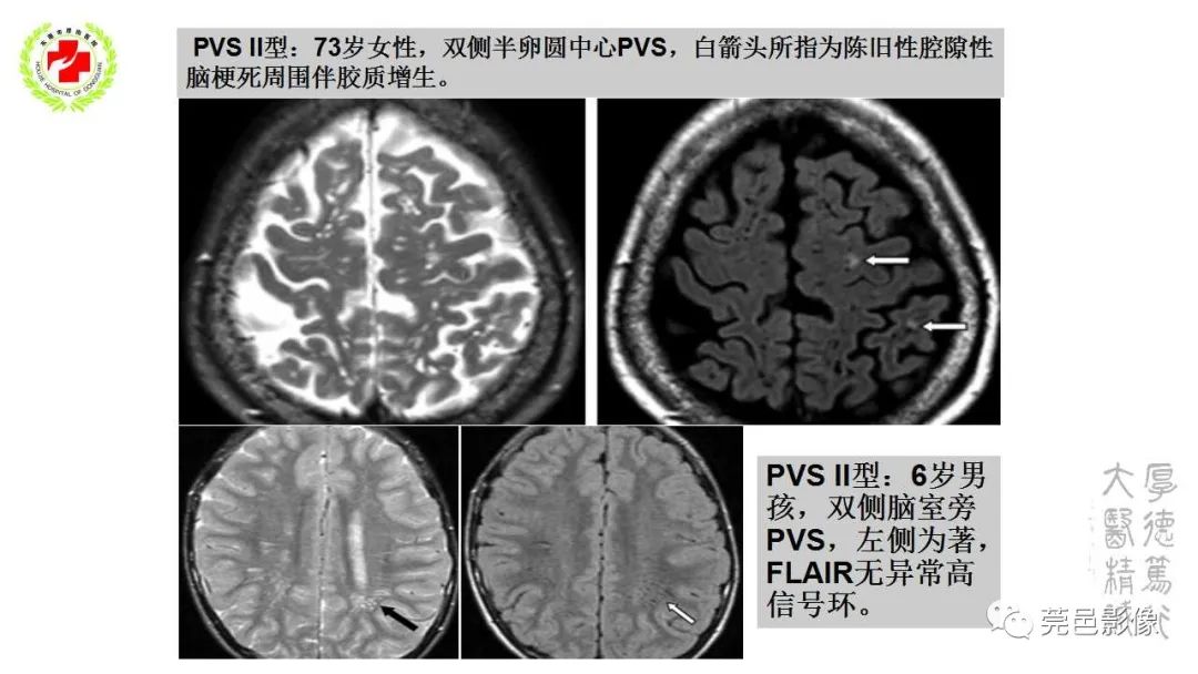 影像PPT - 【PPT】血管周围间隙及相关疾病-11