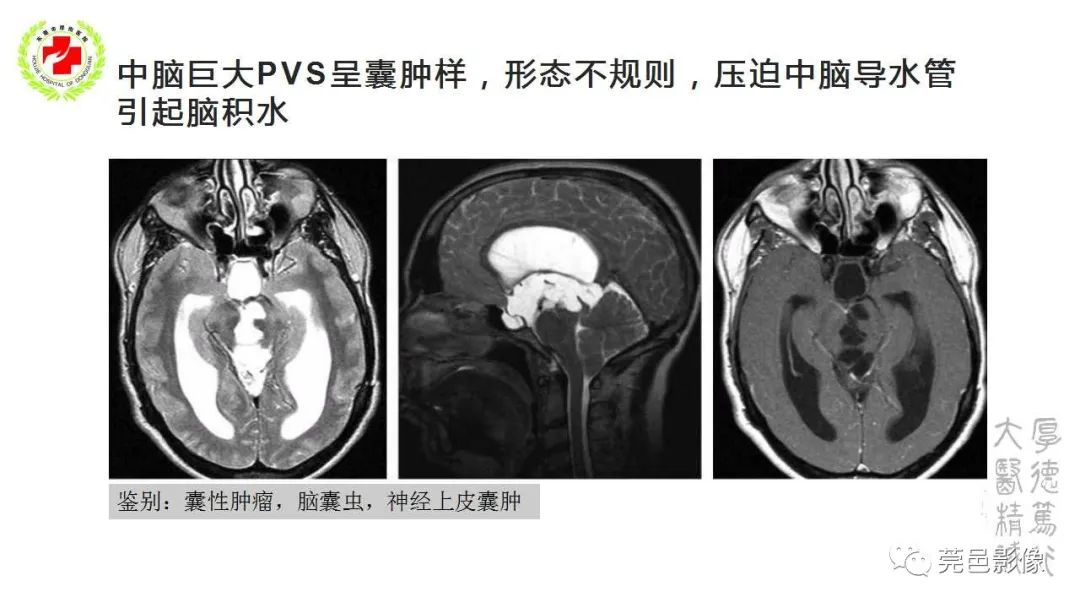 影像PPT - 【PPT】血管周围间隙及相关疾病-14
