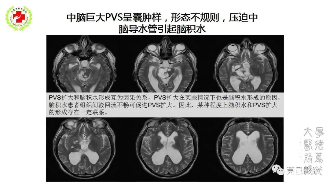 影像PPT - 【PPT】血管周围间隙及相关疾病-15